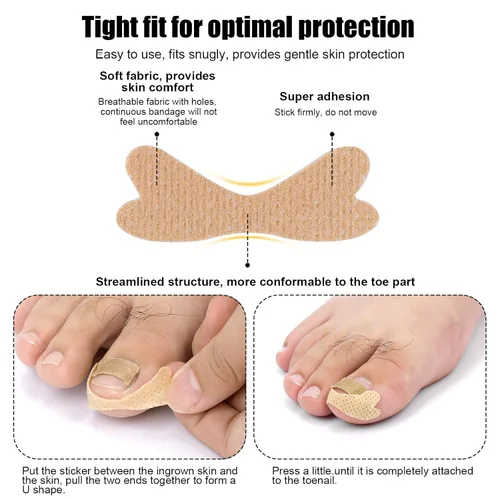 Miniatura 4 de Corrector de uñas encarnadas, 100 parches correctores transpirables con nudo de lazo y 120 tiras de uñas encarnadas ranuradas, herramienta de cinta