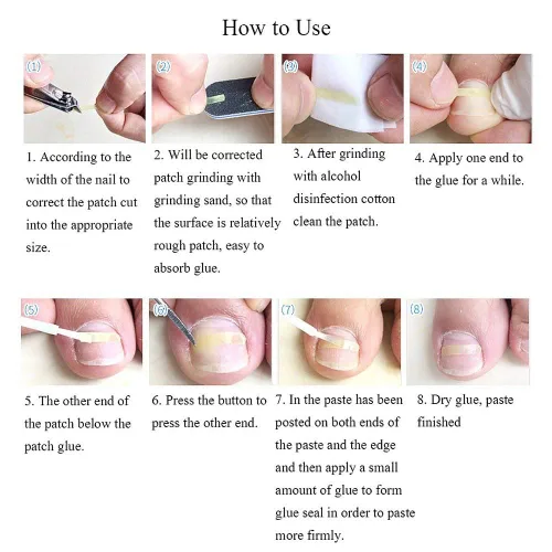 Miniatura 6 de Tiras correctoras de uñas encarnadas Brace 10 unids/botella enderezadora clip curvado BS Brace uñas de los pies gruesa corrección herramienta de pie