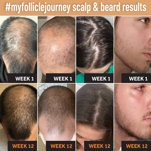 Miniatura 2 de FOLLICLE BOOSTER Masajeador manual para cuero cabelludo y barba, limpiador de silicona para el cabello, cepillo de cuidado de limpieza, exfoliante