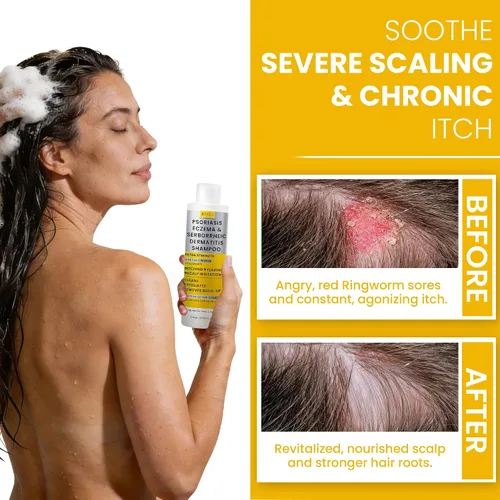 Miniatura 4 de Rida Hair Research Institute Champú para Psoriasis para Hombres y Mujeres Tratamiento del Cuero Cabelludo con Picazón con Miel de Manuka Ideal