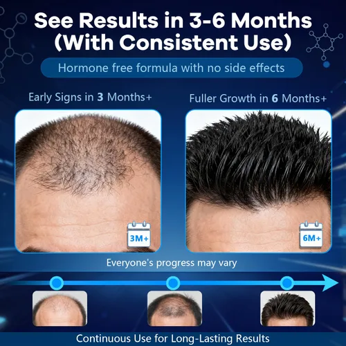 Miniatura 6 de Espuma tópica de minoxidil al 5 %, aerosol de minoxidil para hombres, impregnado con biotina, tratamiento para el crecimiento del cabello, apoya