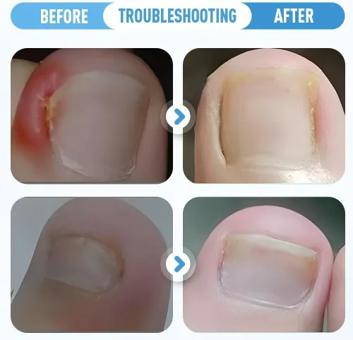 Miniatura 2 de Juego de corrector de uñas encarnadas, tiras correctoras de uñas curvas, lima sin dolor y herramientas de pedicura levantador para mujeres y hombres