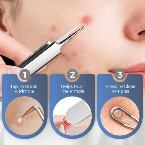 Miniatura 3 de Kit de removedor de espinillas de acero inoxidable, removedor de cabeza negra para cara y nariz, kit de herramientas para eliminar rápida y fácil