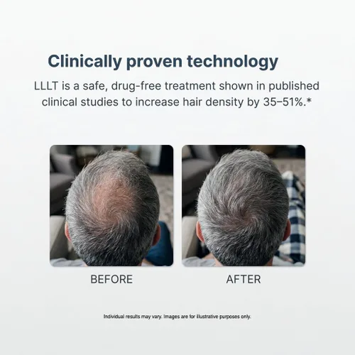 Miniatura 3 de Alpha Hair Growth Laser Cap (136 láseres) Dispositivo de crecimiento láser aprobado por la FDA para hombres y mujeres, tecnología láser SMT, salida