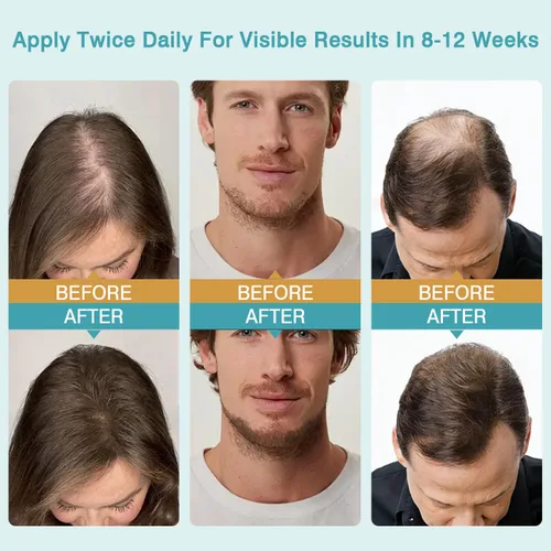 Miniatura 4 de Crema de masaje para el cuero cabelludo de minoxidil al 5%, minoxidil para hombres y mujeres, suero de crecimiento del cabello, minoxidil