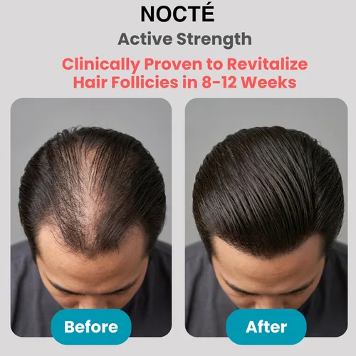 Miniatura 4 de Nocte Spray de suero de crecimiento del cabello minoxidil al 5% para hombres y mujeres – Biotina, cafeína y complejo botánico de romero, tratamiento