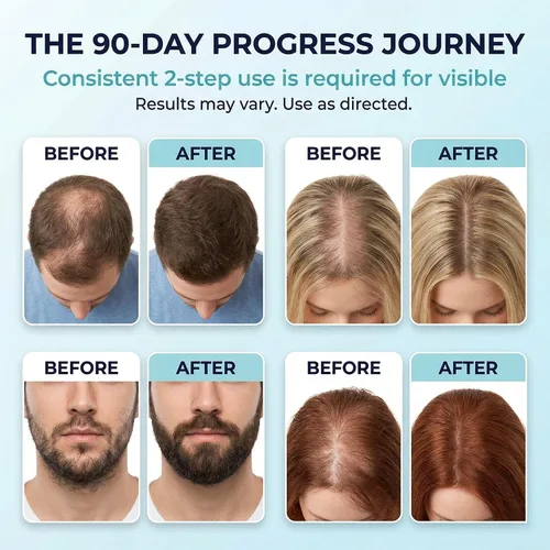 Miniatura 3 de 5% de espuma de minoxidil para hombres y mujeres: paquete de 2 latas de tamaño de viaje de 1 oz - Tratamiento tópico de crecimiento del cabello