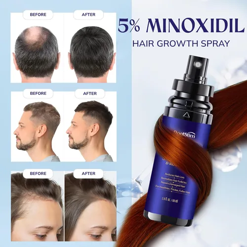 Miniatura 3 de Crecimiento del cabello de minoxidil al 5% para hombres y mujeres: paquete de 2 sueros de tratamiento de pérdida de cabello con minoxidil extra