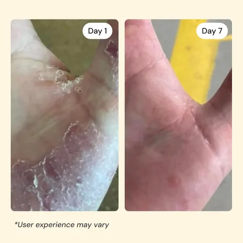 Miniatura 6 de MyMagicHealer Universal Flare Care Sin aceite esencial Alivio para erupciones, eczema, psoriasis, hidradenitis supurativa, impétigo, dermatitis
