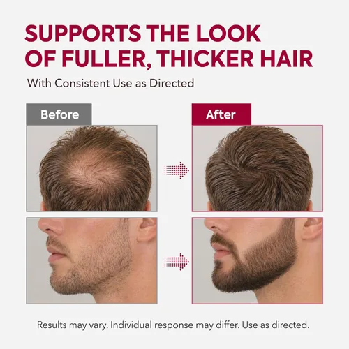 Miniatura 3 de Kit de crecimiento del cabello de minoxidil al 5% para hombres y mujeres: suero de tratamiento de regeneración de barba minoxidil extra fuerte