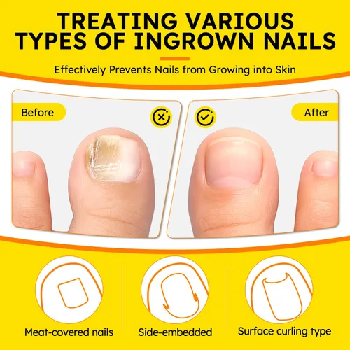 Miniatura 7 de Tratamiento de uñas encarnadas, corrector de uñas curvadas transpirables, tiras correctoras de uñas encarnadas con lima y levantador, kit