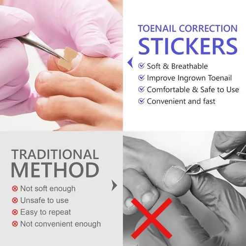 Miniatura 6 de Parche corrector de uñas encarnadas, 100 tiras correctoras de uñas encarnadas, parches de corrección de uñas de los pies, herramienta de tratamiento