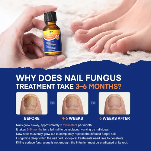 Miniatura 6 de Tratamiento de hongos en las uñas con 25% de ácido undecilénico: tratamiento de hongos en las uñas extra fuerte para uñas gruesas, amarillas