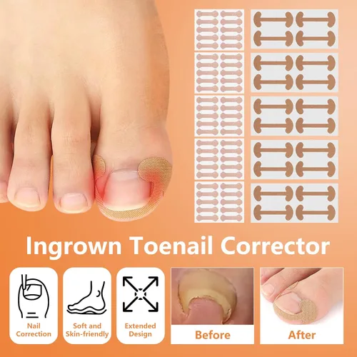 Miniatura 4 de Juego de corrector de uñas encarnadas con tiras correctoras, juego profesional de herramientas de pedicura para uñas encarnadas para hombres