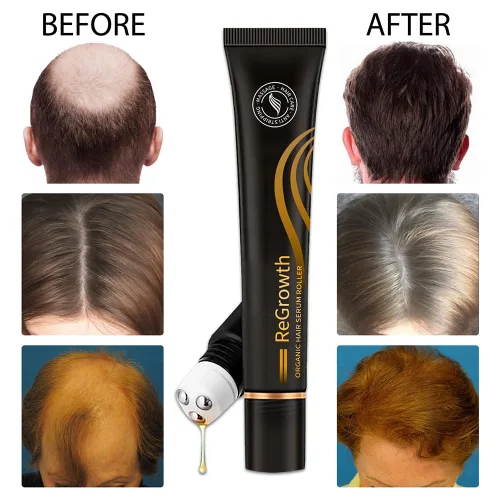 Miniatura 4 de Juego de 10 rodillos de suero orgánico para el crecimiento del cabello, kit de regeneración del cabello orgánico, triple masajeador enrollable