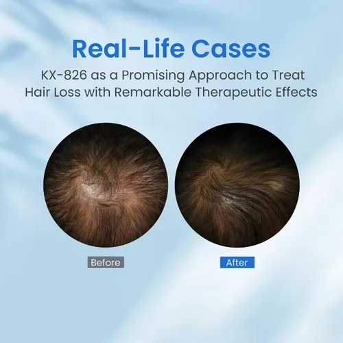 Miniatura 2 de 0.5% KX-826 Spray para el crecimiento del cabello DHT bloqueador de engrosamiento del cabello Tratamientos de regeneración, control de aceite