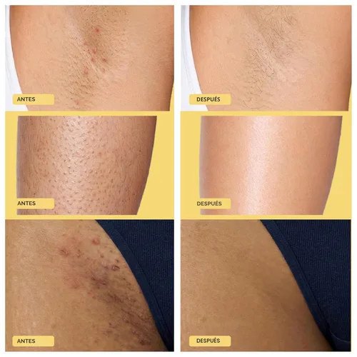 Miniatura 6 de Base Laboratories KP Bump Exfoliating Body Scrub - Con AHA+BHA - Tratamiento de queratosis pilaris - Exfoliante diario para la piel - Ayuda a