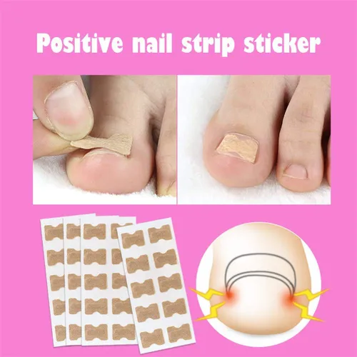 Miniatura 9 de Parche de corrección de uñas encarnadas, 50 calcomanías de uñas encarnadas sin pegamento para uñas encarnadas curvadas para el cuidado de los pies