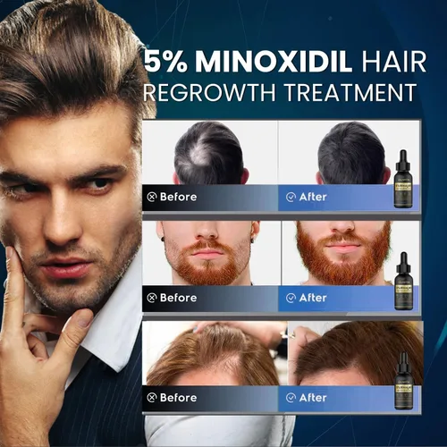 Miniatura 2 de 5 % de Minoxidil para el crecimiento del cabello para hombres y mujeres: Suero de crecimiento del cabello con biotina para la barba y la pérdida