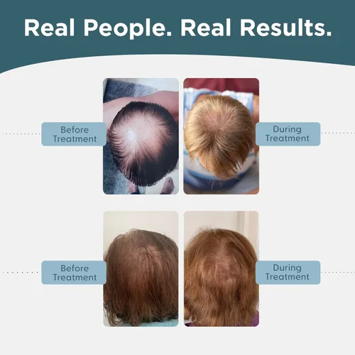 Miniatura 7 de Shapiro MD Hair Growth Experts Minoxidil Solución tópica al 5% para el crecimiento del cabello de los hombres, el suero promueve el crecimiento