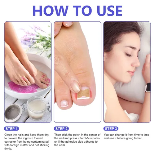Miniatura 7 de Parche corrector de uñas encarnadas, 100 tiras correctoras de uñas encarnadas, parches de corrección de uñas de los pies, herramienta de tratamiento