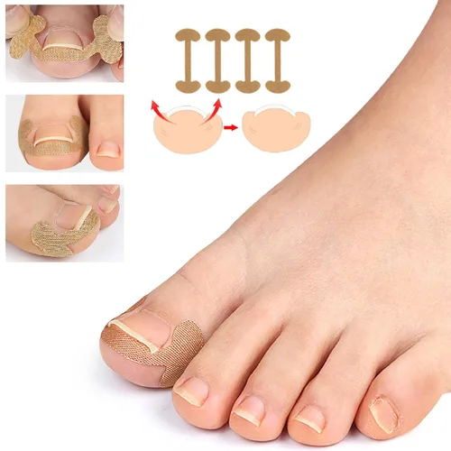 Miniatura 4 de Juego profesional de uñas encarnadas con tiras transpirables de uñas encarnadas, tiras correctoras de uñas de los pies, parche corrector de uñas