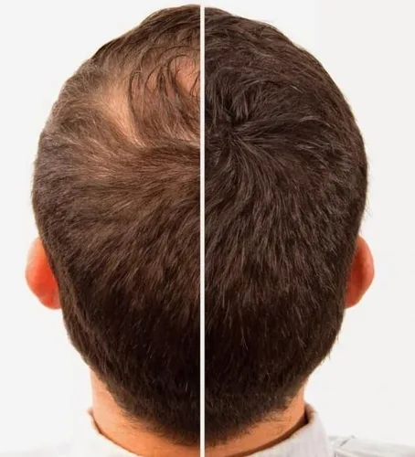 A-Lister - Paquete de recarga de fibras para el cabello Toppik, Nanogen, Xfusion, cualquier marca (0.88 oz, Auburn)