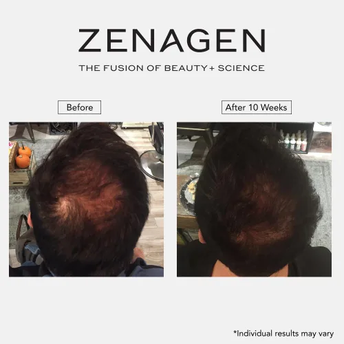 Miniatura 9 de Zenagen Revolve - Tratamiento de pérdida de cabello para hombres