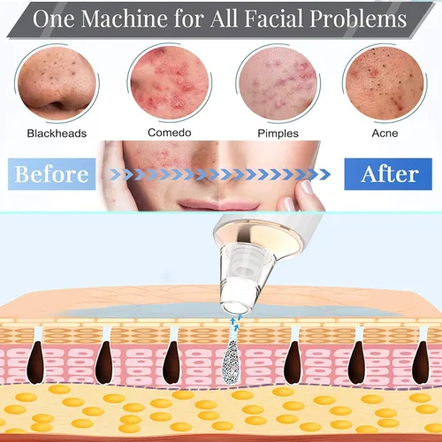 Miniatura 5 de Aspiradora de poros para eliminar puntos negros, limpiador facial recargable por USB, kit de eliminación de puntos negros con 3 potencia de succión