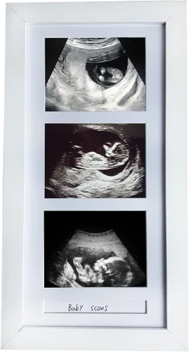 Marcos de fotos de ultrasonido triple, marco de fotos de sonograma, 3 fotos, anuncios de embarazo, regalos de embarazo para madres primerizas, Blanco