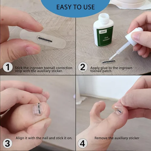 Miniatura 5 de Paquete de 10 piezas de corrector de uñas encarnadas de aleación de titanio, parche de reparación de uñas curvas, herramienta de corrección física