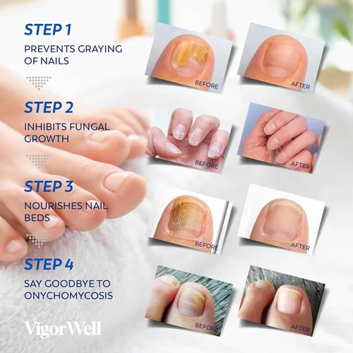 Miniatura 5 de Tratamiento de hongos en las uñas de los pies extra fuerte – Tratamiento de hongos en las uñas para uñas de los pies extra fuerte – Parches