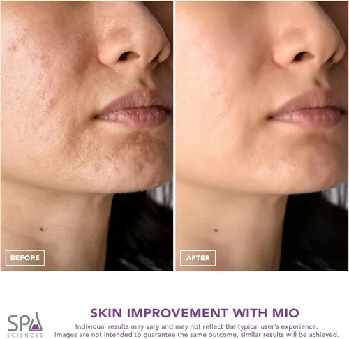 Miniatura 6 de Spa Sciences - MIO - Eliminador de puntos negros de microdermoabrasión con punta de diamante, limpieza de poros y sistema de rejuvenecimiento