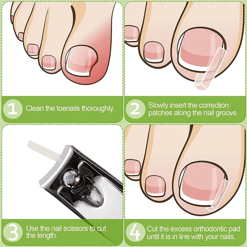 Miniatura 4 de Tiras correctoras de uñas encarnadas profesionales, 50 tiras correctoras de uñas encarnadas, tiras curvadas para enderezar las uñas del pie, clips
