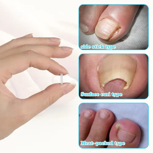 Miniatura 4 de (50+1) Juego de tratamiento corrector de uñas encarnadas, kit profesional de eliminación de uñas encarnadas sin dolor con levantador de uñas