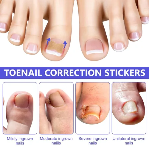 Miniatura 5 de Parche corrector de uñas encarnadas, 100 tiras correctoras de uñas encarnadas, parches de corrección de uñas de los pies, herramienta de tratamiento