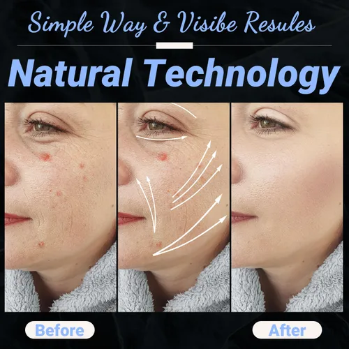 Miniatura 6 de UUPAS - Varita facial de alta frecuencia, portátil de mano 4 en 1, máquina facial azul de alta frecuencia con 4 tubos azules diferentes para uso