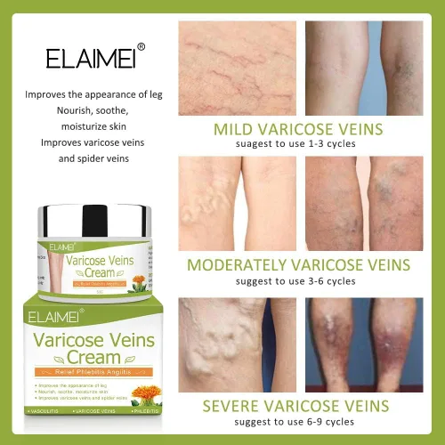Miniatura 4 de Crema para venas varicosas para piernas – Mejora la circulación sanguínea, reduce las venas de araña y la pesadez, alivia la flebitis venas Trata