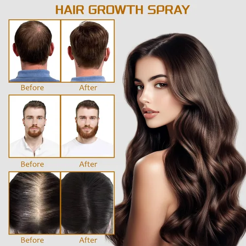 Miniatura 4 de Spray de minoxidil al 5% con biotina de 3.4 fl oz, tratamiento de recrecimiento para hombres y mujeres, promueve el cabello más grueso, más fuerte