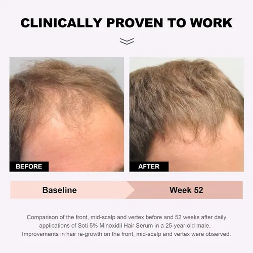 Miniatura 2 de Suero tópico para el crecimiento del cabello de minoxidil al 5% para hombres y mujeres, suero para el crecimiento del cabello para la pérdida