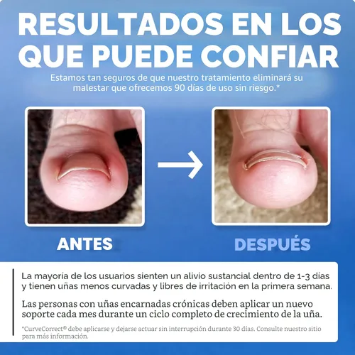 Miniatura 5 de Tratamiento del hogar para uñas encarnadas CurveCorrect