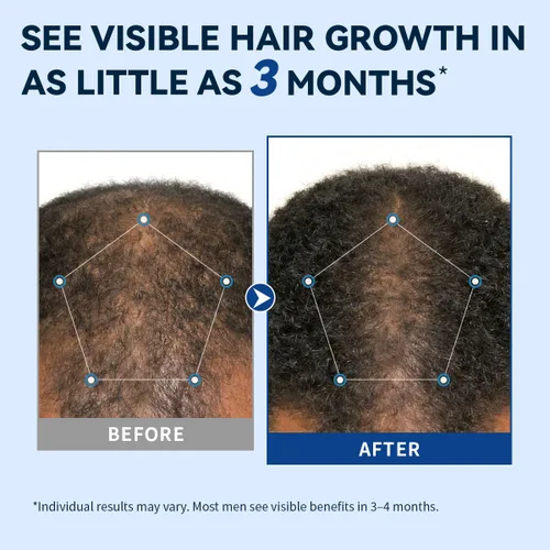 Miniatura 2 de 5% Minoxidil para hombres en aerosol para el crecimiento del cabello, tratamiento extra fuerte para el crecimiento del cabello para hombres