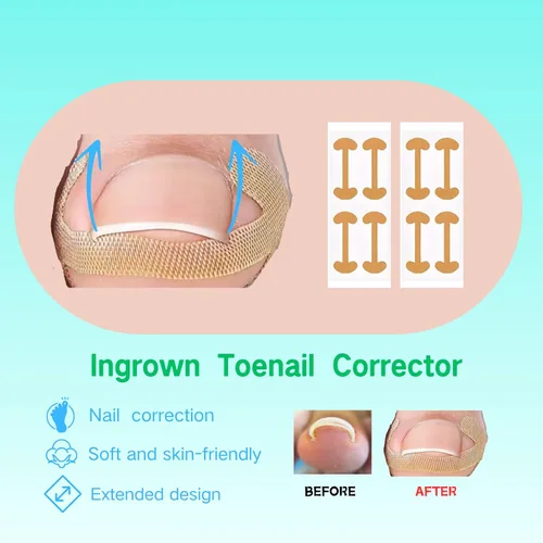 Miniatura 3 de Juego de corrector de uñas encarnadas con parche de corrección de uñas curvas, kit de eliminación de uñas mejorado, herramientas de pedicura
