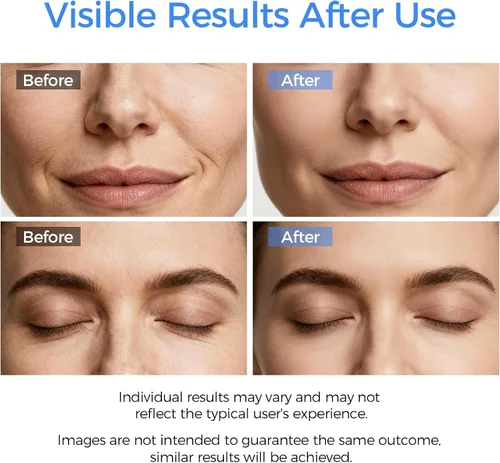 Miniatura 3 de Espátula facial para exfoliar la piel, herramienta removedor de puntos negros para limpieza profunda facial, limpiador de poros con 4 modos, Blanco