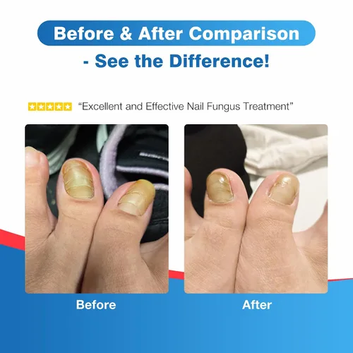 Miniatura 6 de Tratamiento de hongos en las uñas de los pies extra fuerte – DR.RAPID - Bolígrafo de tratamiento de hongos en las uñas con 25% de ácido undecilénico