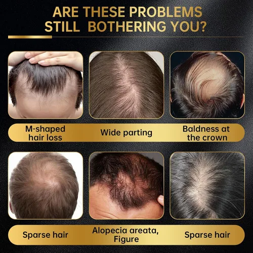 Miniatura 2 de Solución tópica de minoxidil USP 5% para hombres y mujeres - Tratamiento de crecimiento capilar OTC, fármaco monográfico de la FDA, fórmula no grasa