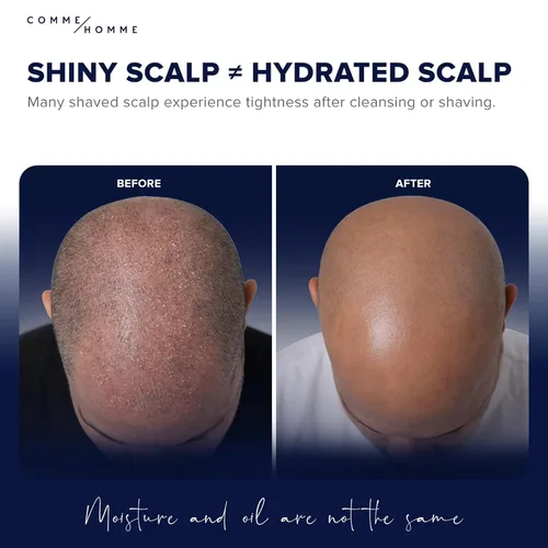 Miniatura 3 de Comme Homme Hidratante calmante para el cuero cabelludo para hombres calvos Hidrata, suaviza y ralentiza el nuevo crecimiento con aloe
