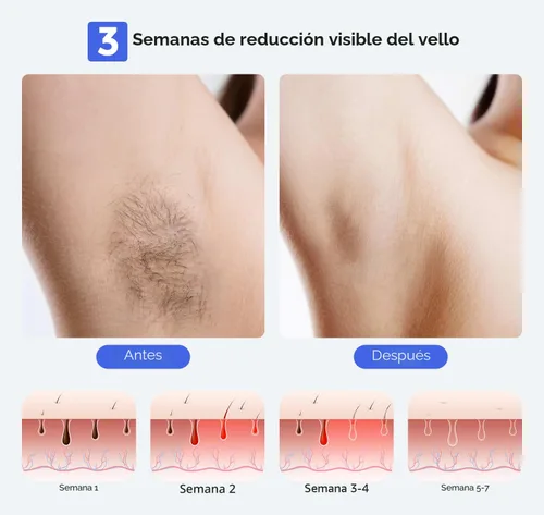 Miniatura 4 de LUBEX Depilación láser IPL permanente inteligente para mujeres y hombres, zafiro sin dolor, refrigeración por hielo, alternativa a la peluquería
