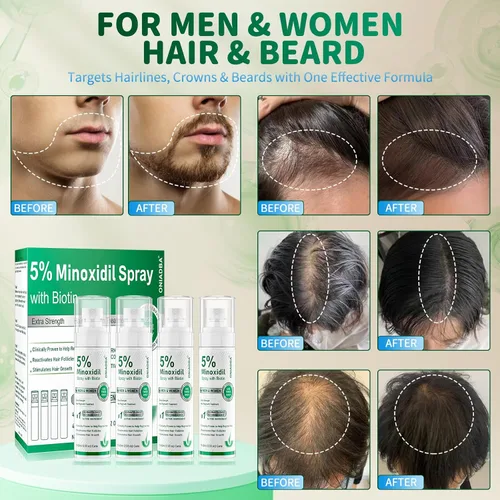 Miniatura 2 de Spray de minoxidil al 5 % para el crecimiento del cabello, paquete de 4 (8.12 onzas), para hombres y mujeres, tratamiento de crecimiento del cabello
