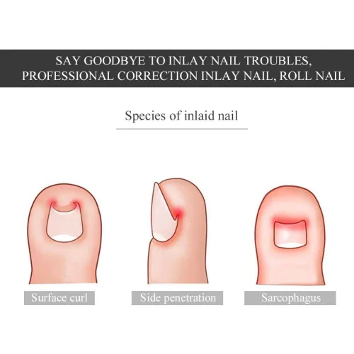 Miniatura 9 de Corrector de uñas pedicura herramienta de cuidado de pies, 12 unids/caja de herramienta de corrección de uñas de los pies, 6 tamaños encarnados